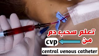 تعلم الطريقه الصحيحه لسحب الدم منCVP