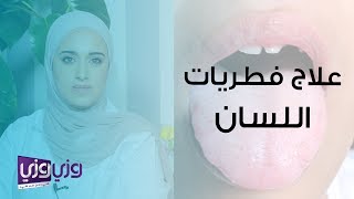 علاج فطريات اللسان البيضاء