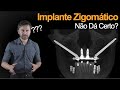 É Por Isso Que Implante Zigomático Não Dá Certo! - Bizarrices Científicas