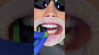 Checking the bite. #veneers #oddlysatisfying #asmr #asmrsounds #porcelainveneers #satisfying #teeth