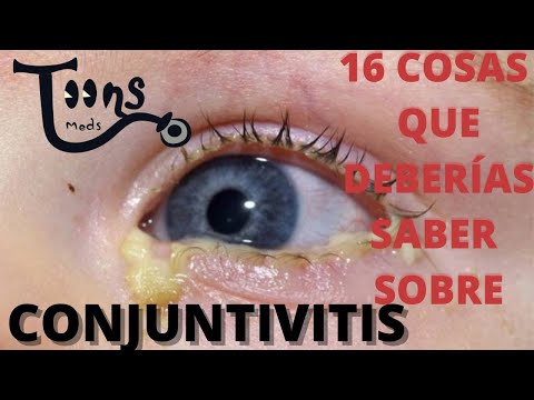 Video: Cómo prevenir la propagación de la conjuntivitis: 14 pasos (con imágenes)