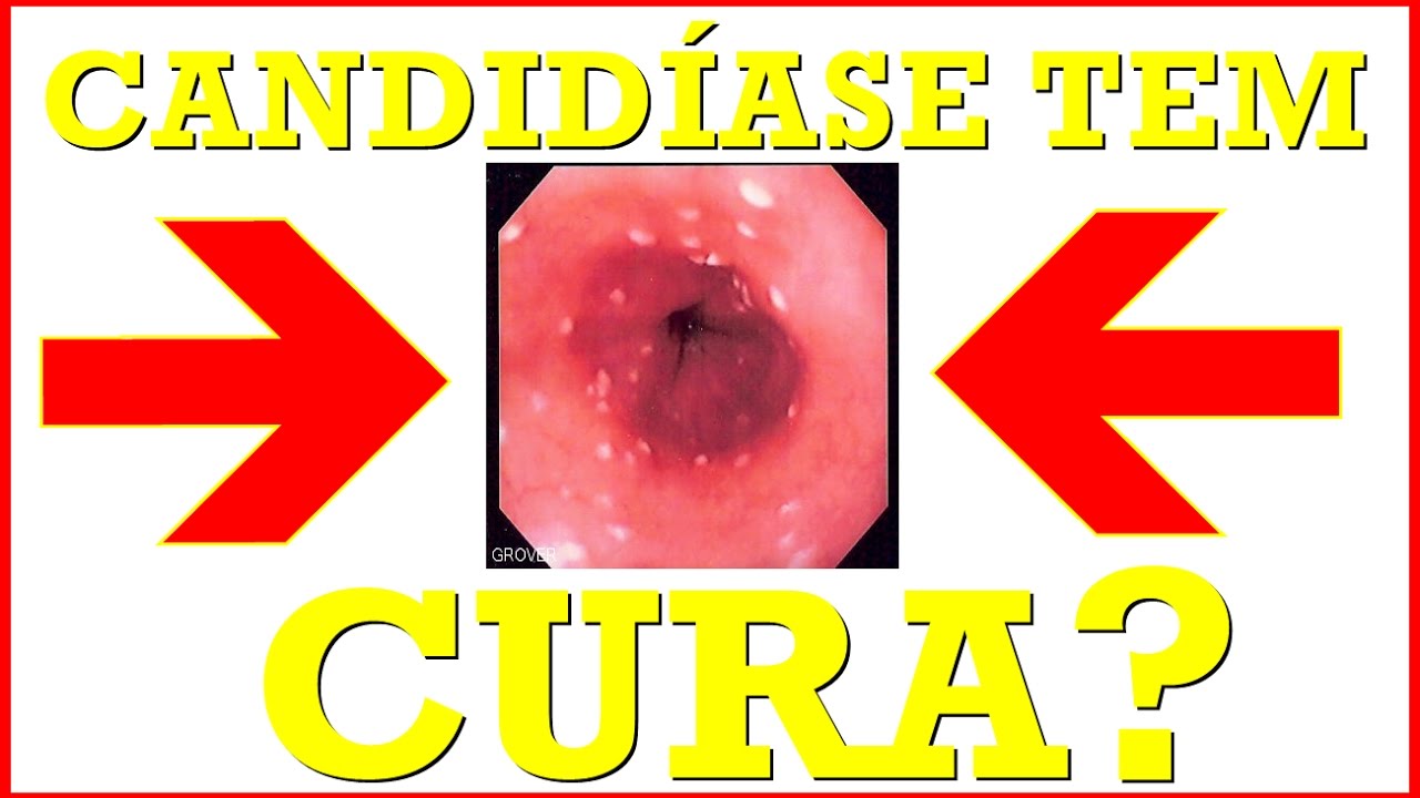 Candidiase Tem Cura Conheca Os Sintomas Tratamento Como