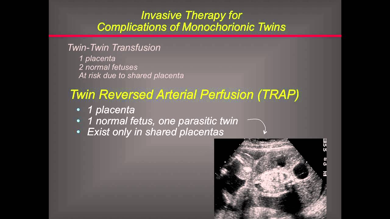 UCSF Radiology: Operating on Twins in the Womb
