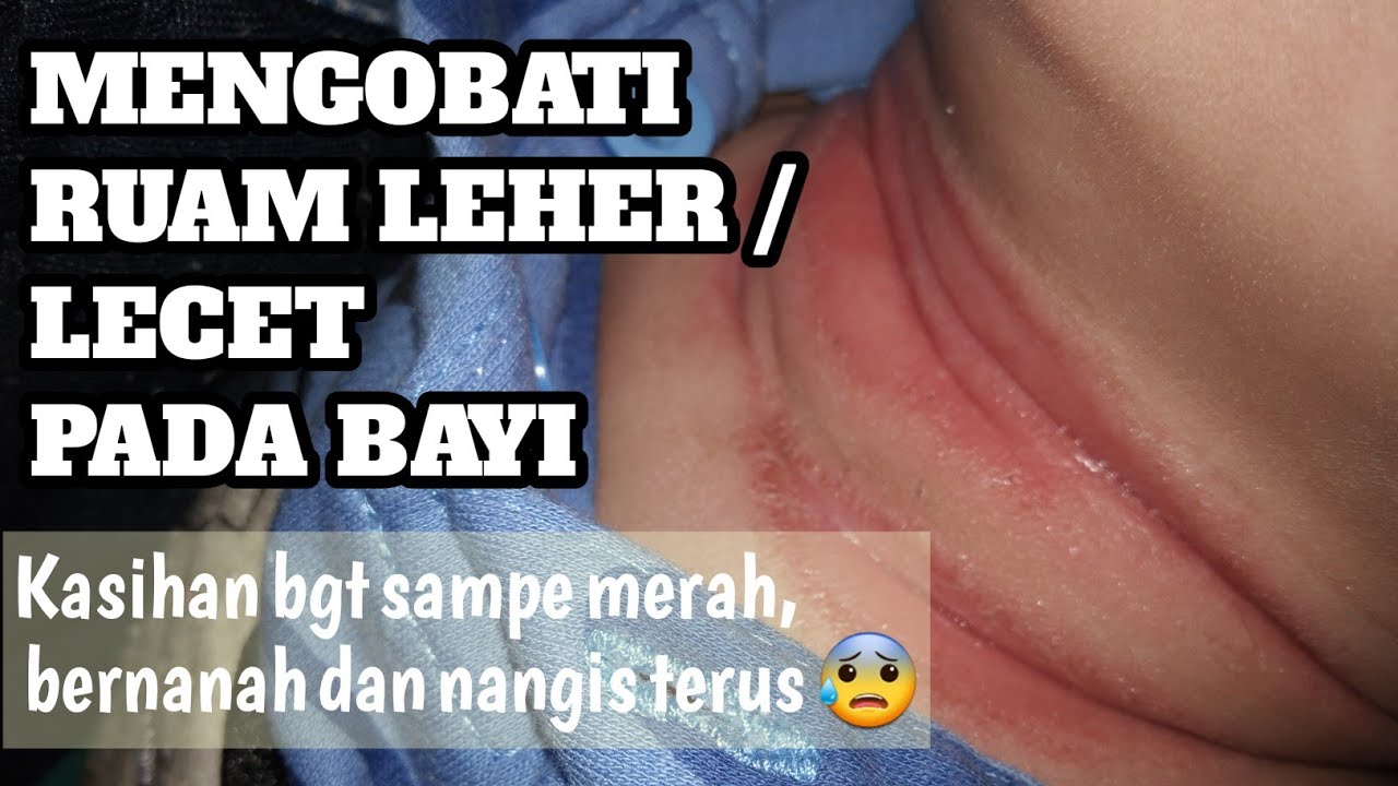 Cara Mengobati Ruam Leher Pada Bayi 