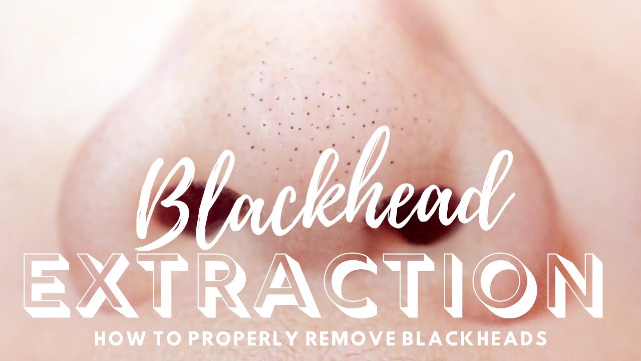 Blackhead Removal on the Nose How to Properly Extract Blackheads