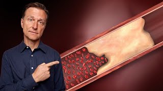 The REAL Reason Why Your Arteries Are Calcifying and Turning into Bone The Real Reason Why Your Arteries Are Calcifying And Turning Into Bone