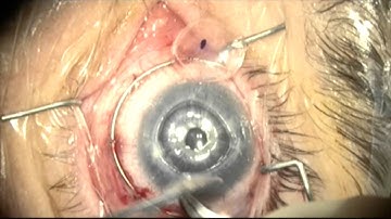 Penetrating Keratoplasty in Buphthalmic eye by Steven G. Safran MD