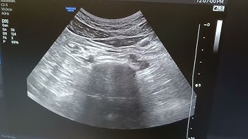 simple scan of superior hypogastric plexus