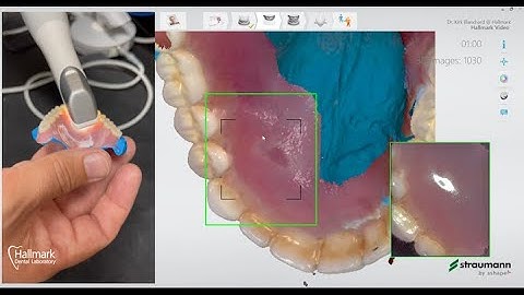 Scanning a Denture with a Trios IOS