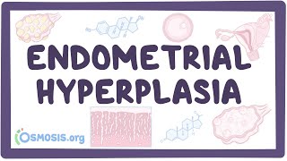 Endometrial hyperplasia - causes, symptoms, diagnosis, treatment, pathology