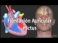 Fibrilación Auricular e Ictus, Animación. Alila Medical Media Español.