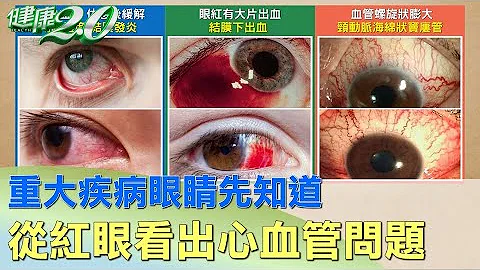 重大疾病眼睛先知道 從紅眼看出你的心血管問題 健康2.0 - 天天要聞