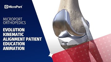 Evolution Kinematic Alignment Patient Education Animation