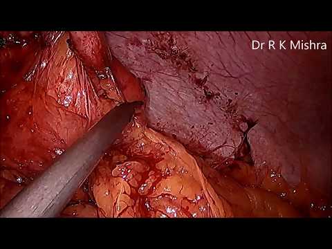 Laparoscopic Surgery for Subacute Small Bowel Obstruction
