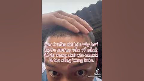 HÀNH TRÌNH CẤY TÓC THÀNH CÔNG: kết quả đáng kinh ngạc sau 2 năm