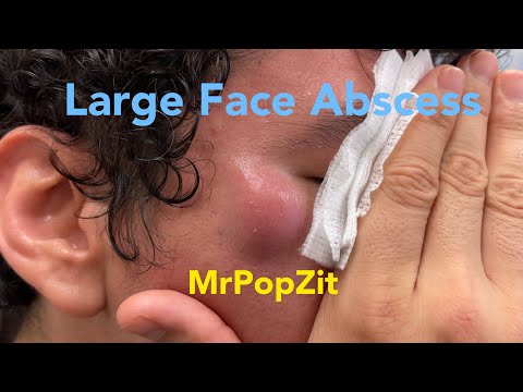Large face Abscess (inflamed cyst)drained near eye with one week follow up. Healed amazingly!
