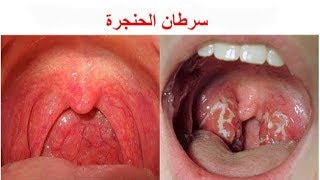 سرطان الحنجرة  الأعراض والعلاجات