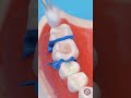 Cuida tus dientes: así se ve una cirugía dental desde la perspectiva del doctor 🦷