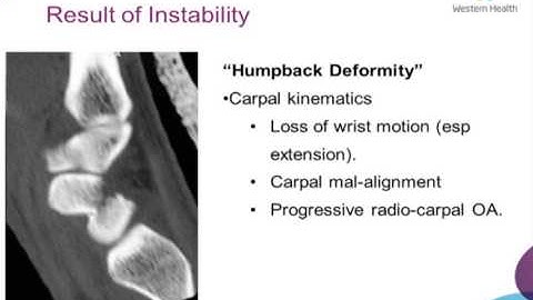 Scaphoid Fractures by Dr Pandelis Dimitriou