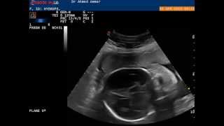 Hydrops Cystic Hygroma