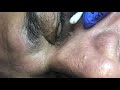 Old eye blackheads part 2 by drlalit kasana