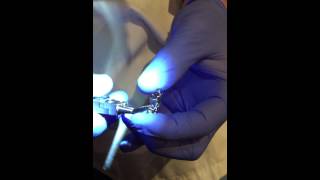 Okotoks Orthodontics: Crozat video