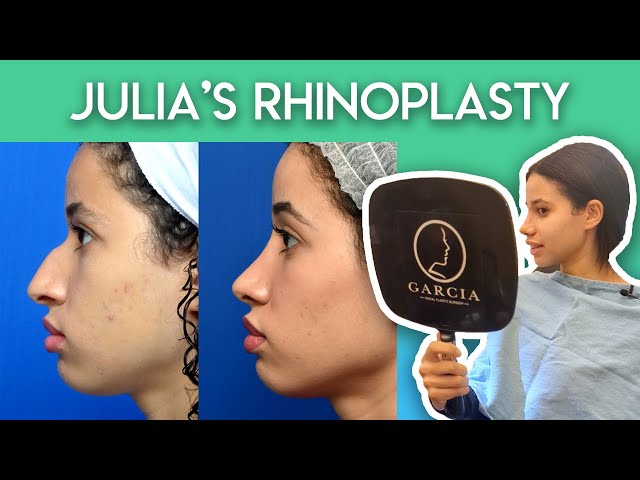 Julia's Rhinoplasty Journey