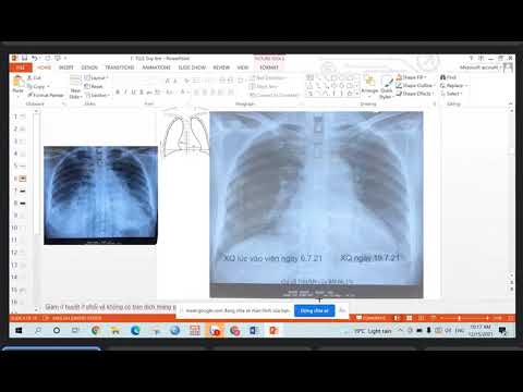 Video case lâm sàng suy tim - youtube