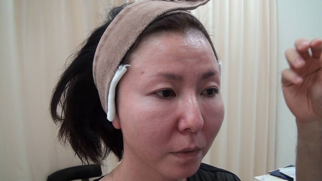 高須クリニック タレ目形成手術 グラマラスライン 二重まぶた全切開法に準じたたるみ取りの術前デザイン解説 美容整形外科動画 Youtube 高須クリニック タレ目形成手術 グラマラスライン 二重まぶた全切開法に準じたたるみ取りの術前デザイン解説 美容整形外科動画 Youtube