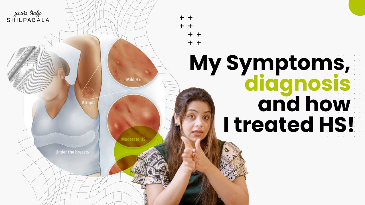 All you want to know about my skin condition| HS | Symptoms and treatment | Shilpa Bala |