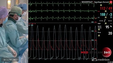 TAVI Using A Navitor SEV