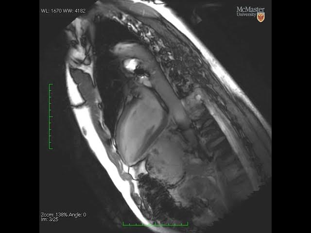 MRI video of the human heart