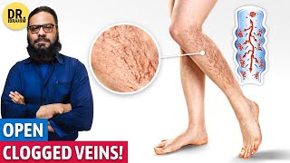 Band Naso Ko Khole Ka Qudrati Ilaj Naturally Treat Varicose Veins Dr. Ibrahim