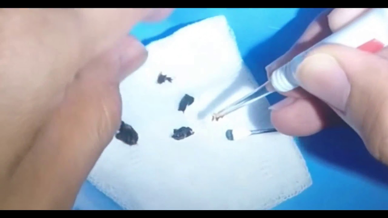 Ear Wax Extraction (part 1) YouTube