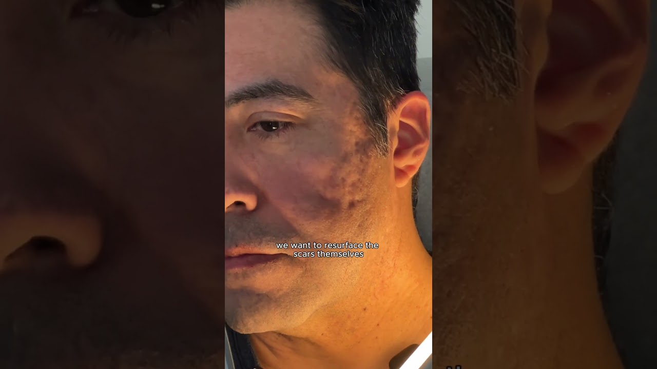 Acne Scar Consultation with Dr. Qazi 