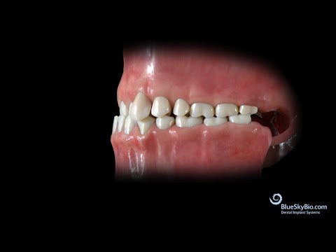 Video: Crossbite: Definiție, Imagini, Cauze și Tratament