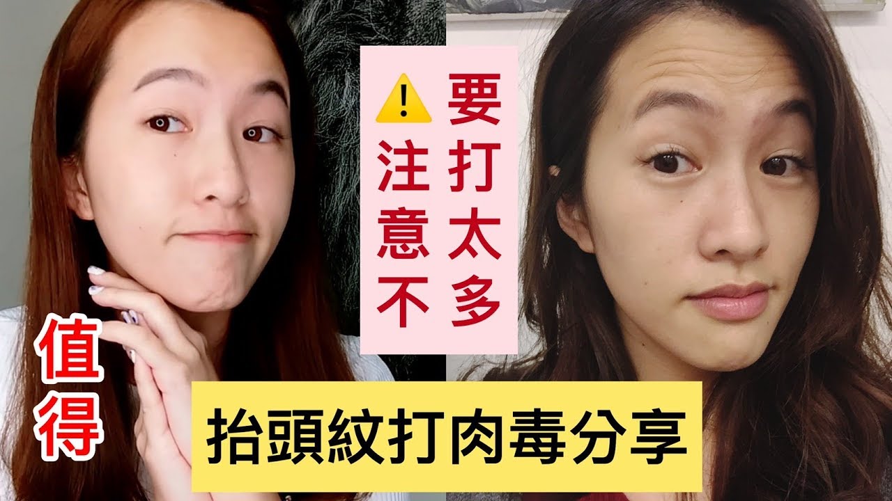 抬頭紋打肉毒心得 肉毒打太多眼睛張不太開分享 Youtube