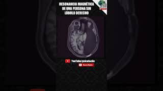 IMAGEN DE UNA PERSONA CON MEDIO CEREBRO 😱🧠🧠 | RESONANCIA MAGNÉTICA #shorts