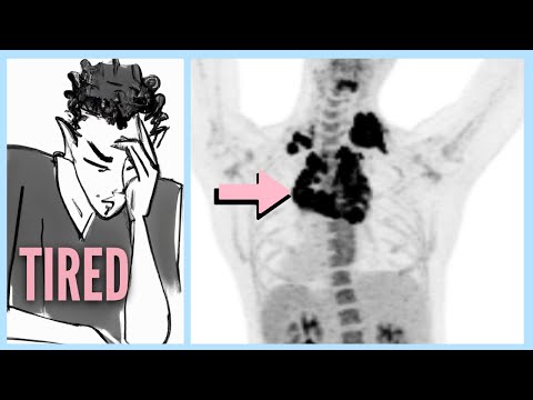 Video: Är lymfomklumpar synliga?