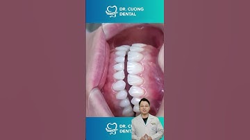 Hàm răng sau niềng |Dr Cường Official