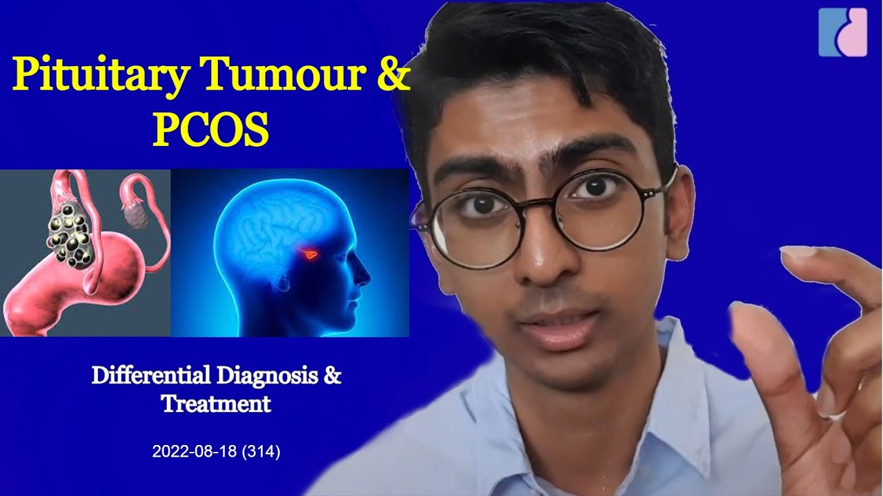 Pituitary Tumor And Pcos Differential Diagnosis Antai Hospitals Youtube