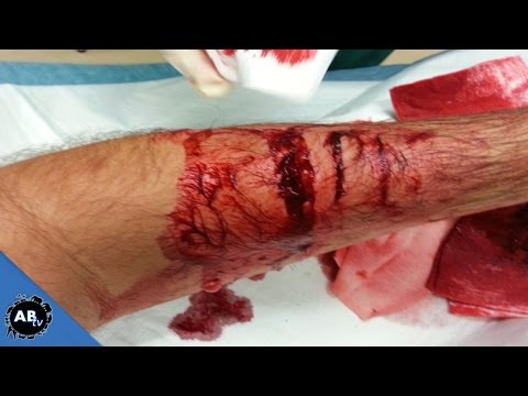 My Worst Snake Bite Ever! EP. 422 SnakeBytesTV : AnimalBytesTV