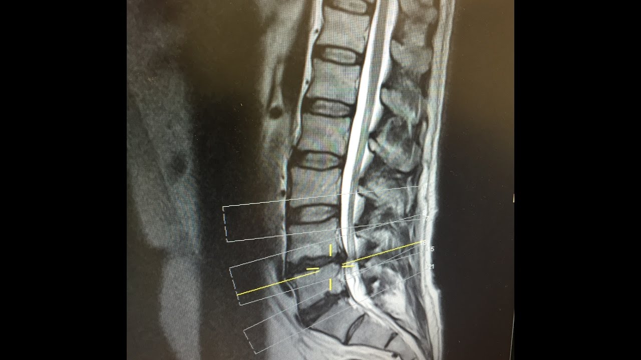 Day 6 after L4/L5 Microdiscectomy Lumbar Back Surgery for