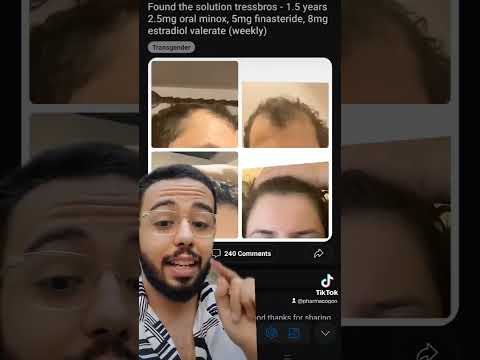 أستخدم حبوب إستروجين علشان يرجع شعره أغرب نتائج موقع ريديت