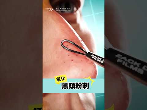 黑頭怎麼來的?這才是正確清粉刺的方法! #黑頭粉刺 #粉刺 #青春痘 #痘痘 #清粉刺 #粉刺棒