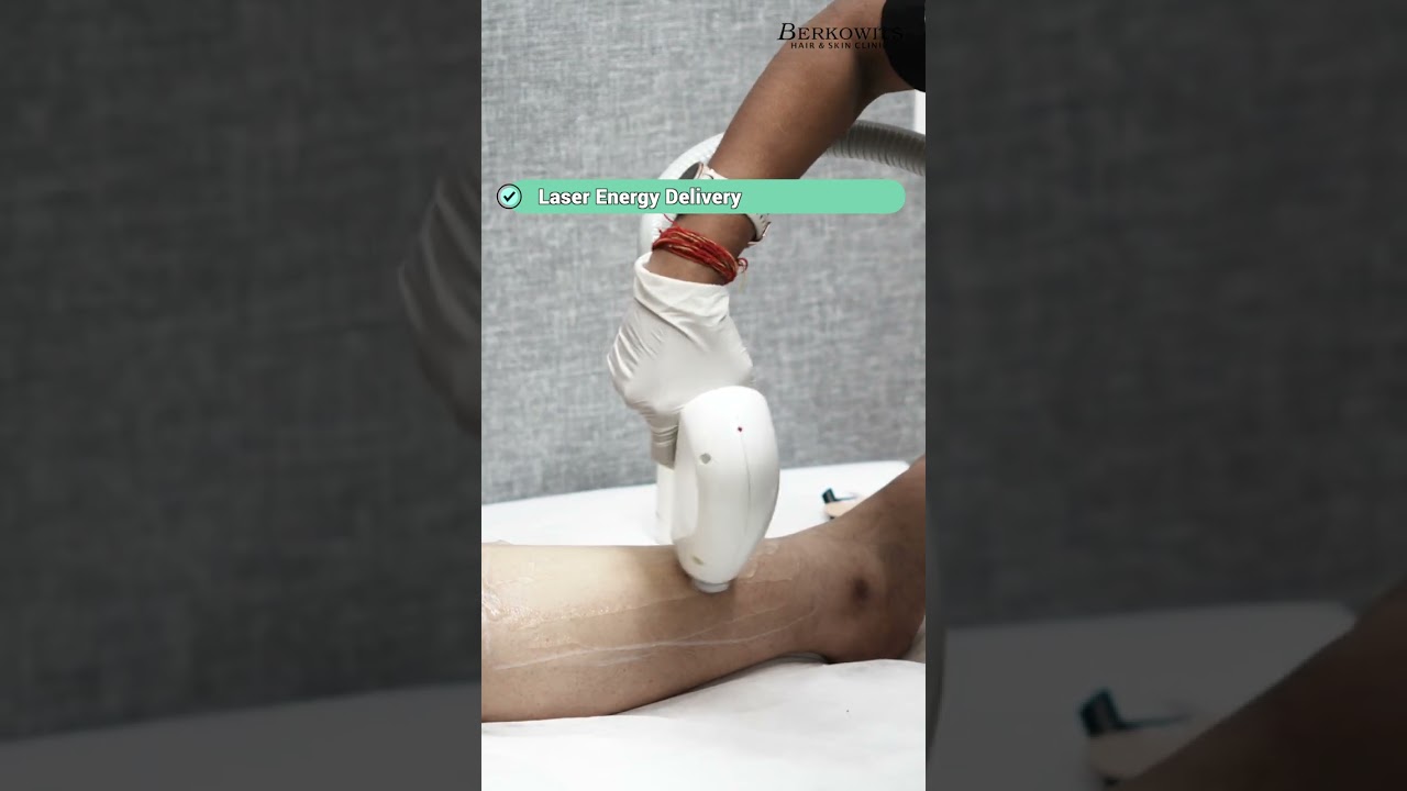Laser Hair Reduction Session | See the LHR Procedure at Berkowits
