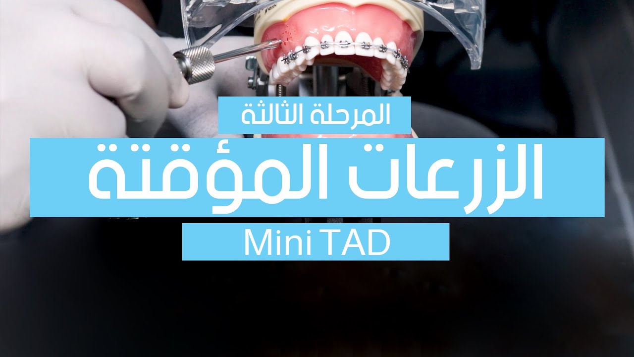 Mini TAD تركيب الزرعات المؤقتة