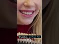 Cracked, stained, or damaged teeth? 🦷 The big question is: Veneers or Crowns? #invisalign #bracket