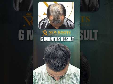 From Bald to Bold: 6 Months Hair Transplant Transformation #hairtransplant #shorts
