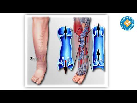 Видео: 3 начина за намаляване на подуването на краката